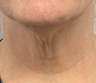 gig-harbor-medical-spa-before-potenza-1
